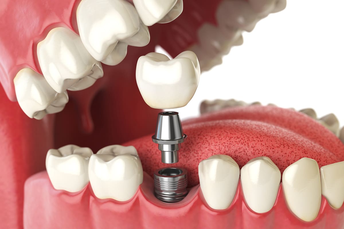 What Makes A Good Candidate For Dental Implants Blog